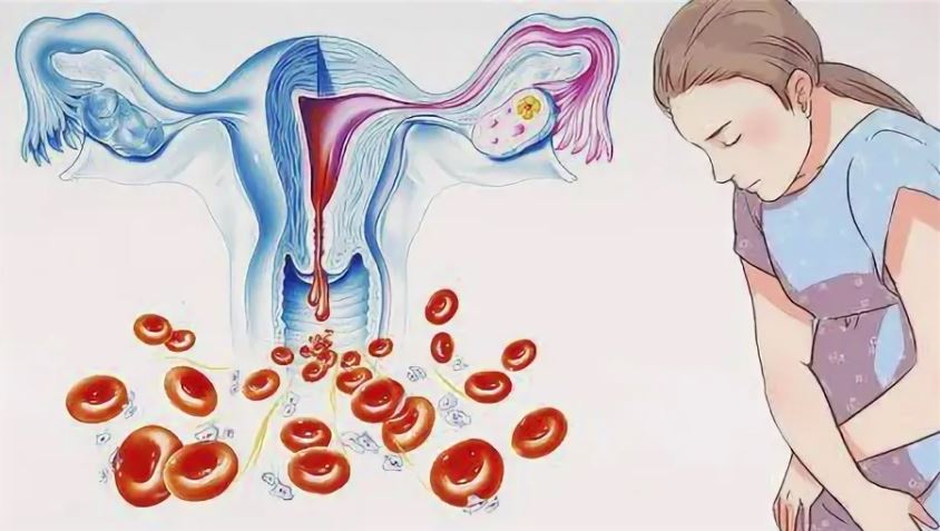 Обильная менструация